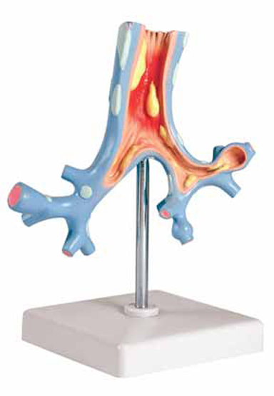 Pathological Model of the Bronchi